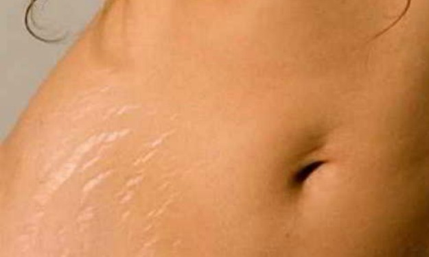 7 Things That Help You Get Rid Of Stretch Marks